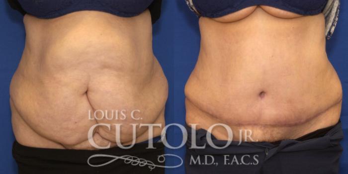 Before & After Tummy Tuck Case 221 View #1 View in Brooklyn, Staten Island, Queens, NY