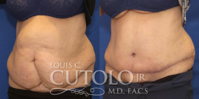 Before & After Tummy Tuck Case 221 View #2 View in Brooklyn, Staten Island, Queens, NY