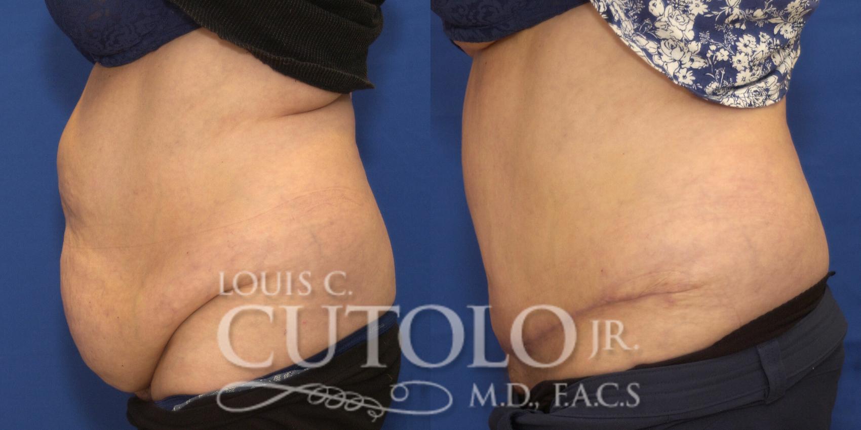 Before & After Tummy Tuck Case 221 View #3 View in Brooklyn, Staten Island, Queens, NY