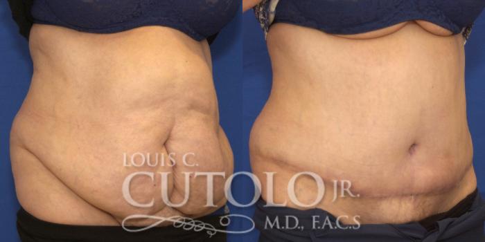 Before & After Tummy Tuck Case 221 View #4 View in Brooklyn, Staten Island, Queens, NY