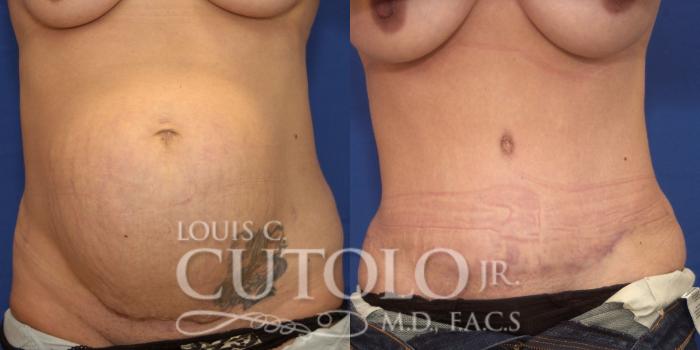 Before & After Tummy Tuck Case 236 Front View in Brooklyn, Staten Island, Queens, NY
