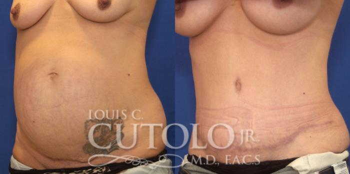 Before & After Tummy Tuck Case 236 Left Oblique View in Brooklyn, Staten Island, Queens, NY