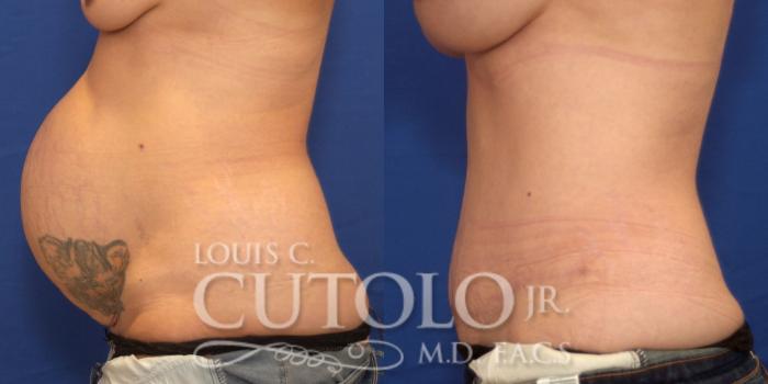 Before & After Tummy Tuck Case 236 Left Side View in Brooklyn, Staten Island, Queens, NY