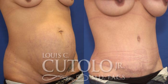 Before & After Tummy Tuck Case 236 Right Oblique View in Brooklyn, Staten Island, Queens, NY