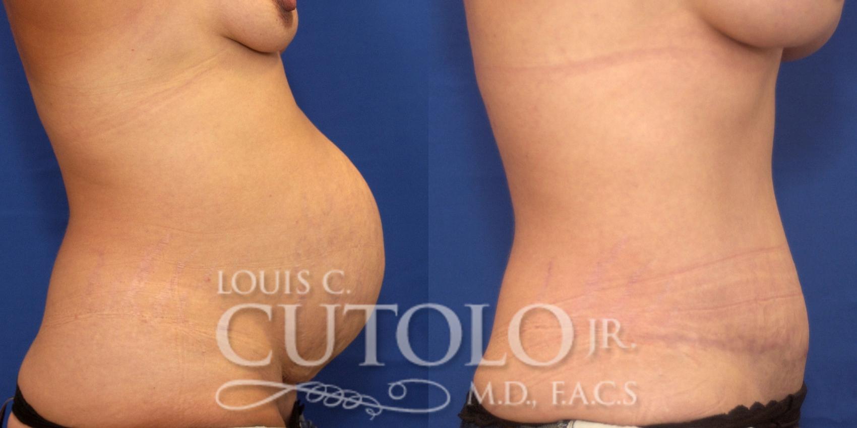 Before & After Tummy Tuck Case 236 Right Side View in Brooklyn, Staten Island, Queens, NY
