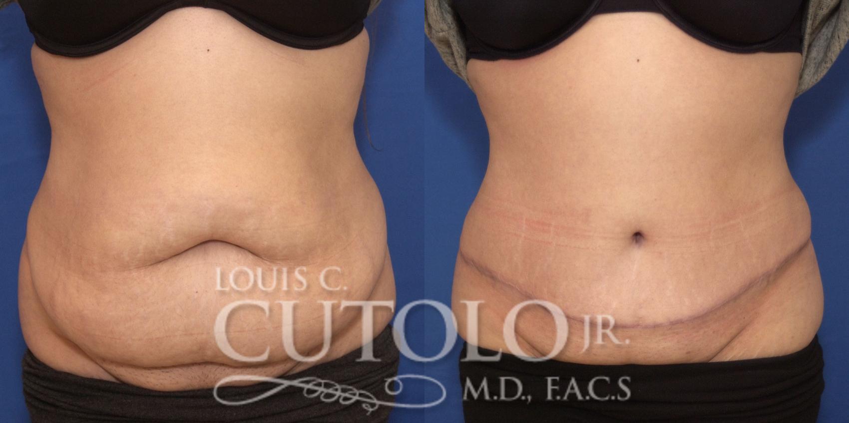 Before & After Tummy Tuck Case 243 Front View in Brooklyn, Staten Island, Queens, NY