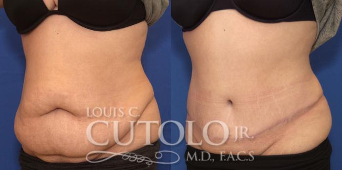 Before & After Tummy Tuck Case 243 Left Oblique View in Brooklyn, Staten Island, Queens, NY