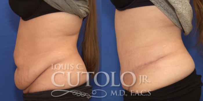 Before & After Tummy Tuck Case 243 Left Side View in Brooklyn, Staten Island, Queens, NY
