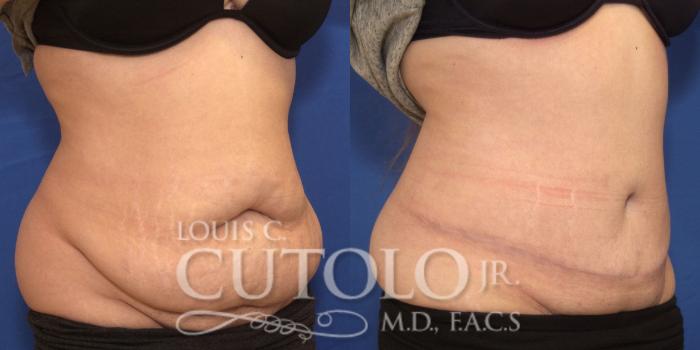 Before & After Tummy Tuck Case 243 Right Oblique View in Brooklyn, Staten Island, Queens, NY