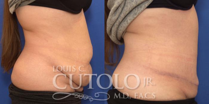 Before & After Tummy Tuck Case 243 Right Side View in Brooklyn, Staten Island, Queens, NY