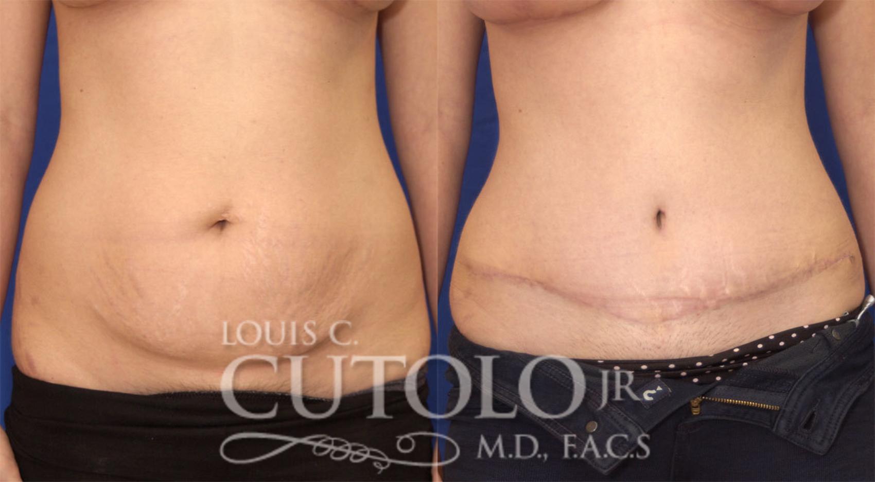 Before & After Tummy Tuck Case 25 View #1 View in Brooklyn, Staten Island, Queens, NY