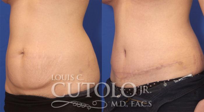 Before & After Tummy Tuck Case 25 View #2 View in Brooklyn, Staten Island, Queens, NY
