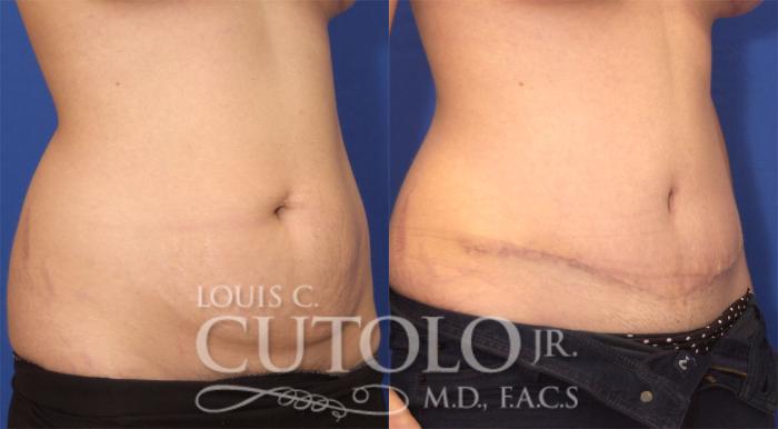 Before & After Tummy Tuck Case 25 View #3 View in Brooklyn, Staten Island, Queens, NY