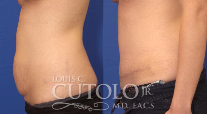 Before & After Tummy Tuck Case 25 View #4 View in Brooklyn, Staten Island, Queens, NY