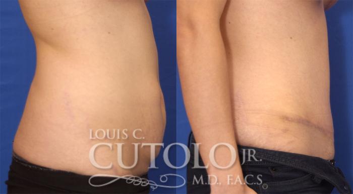 Before & After Tummy Tuck Case 25 View #5 View in Brooklyn, Staten Island, Queens, NY