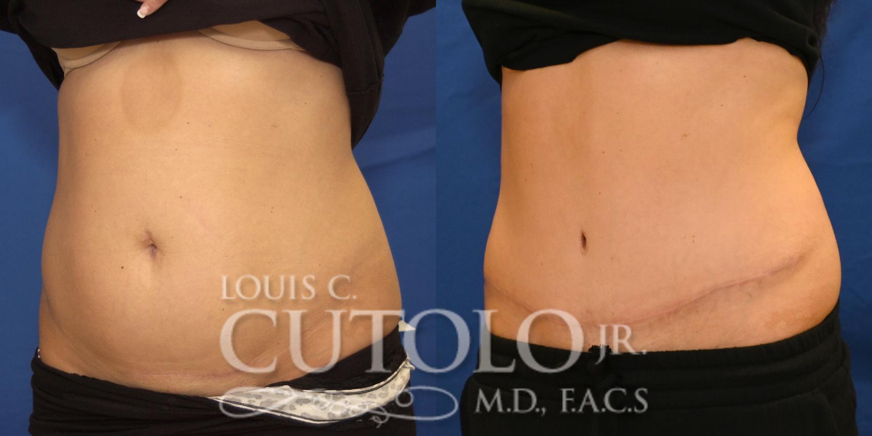 Left Oblique Before