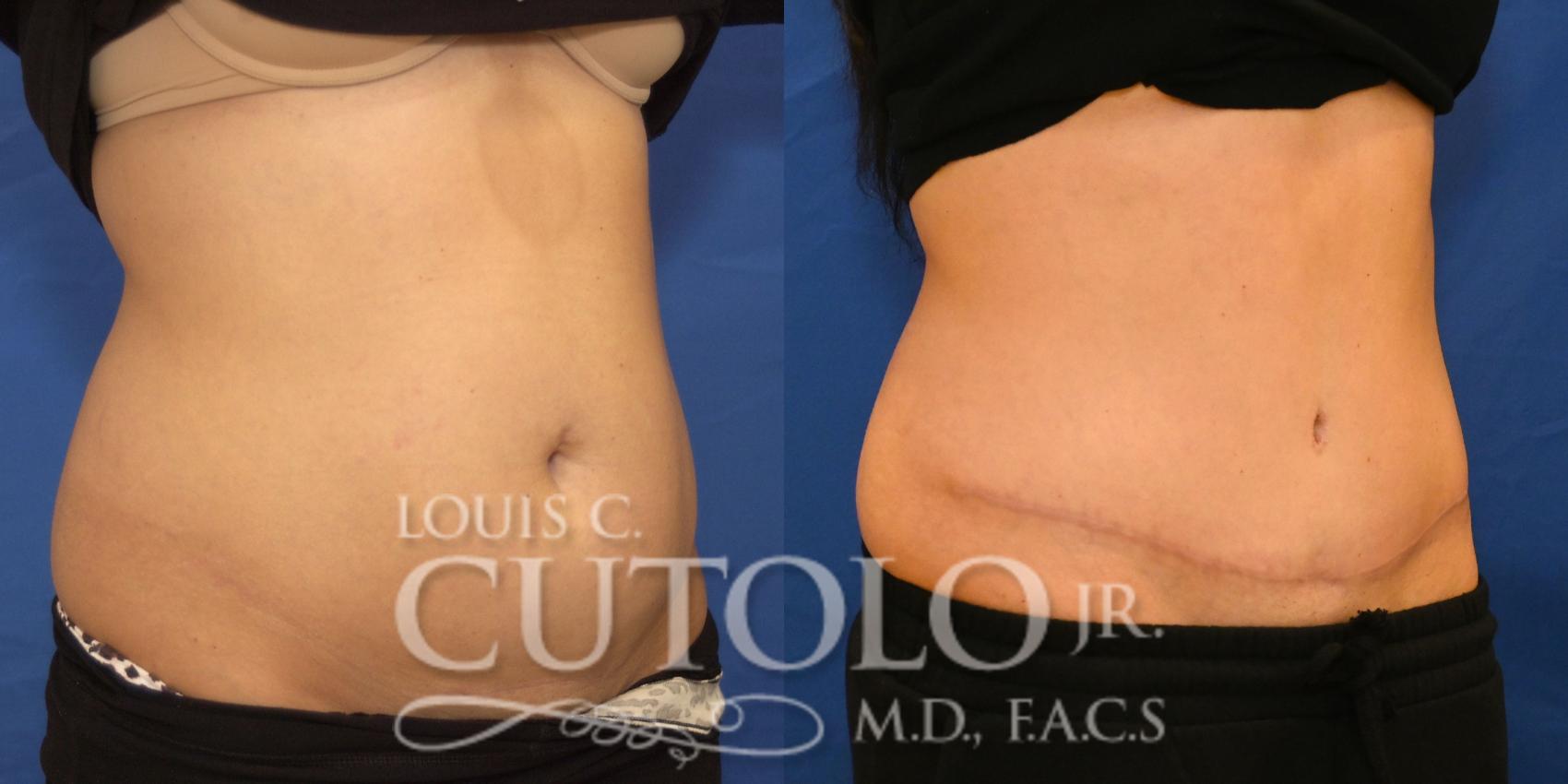 Right Oblique Before
