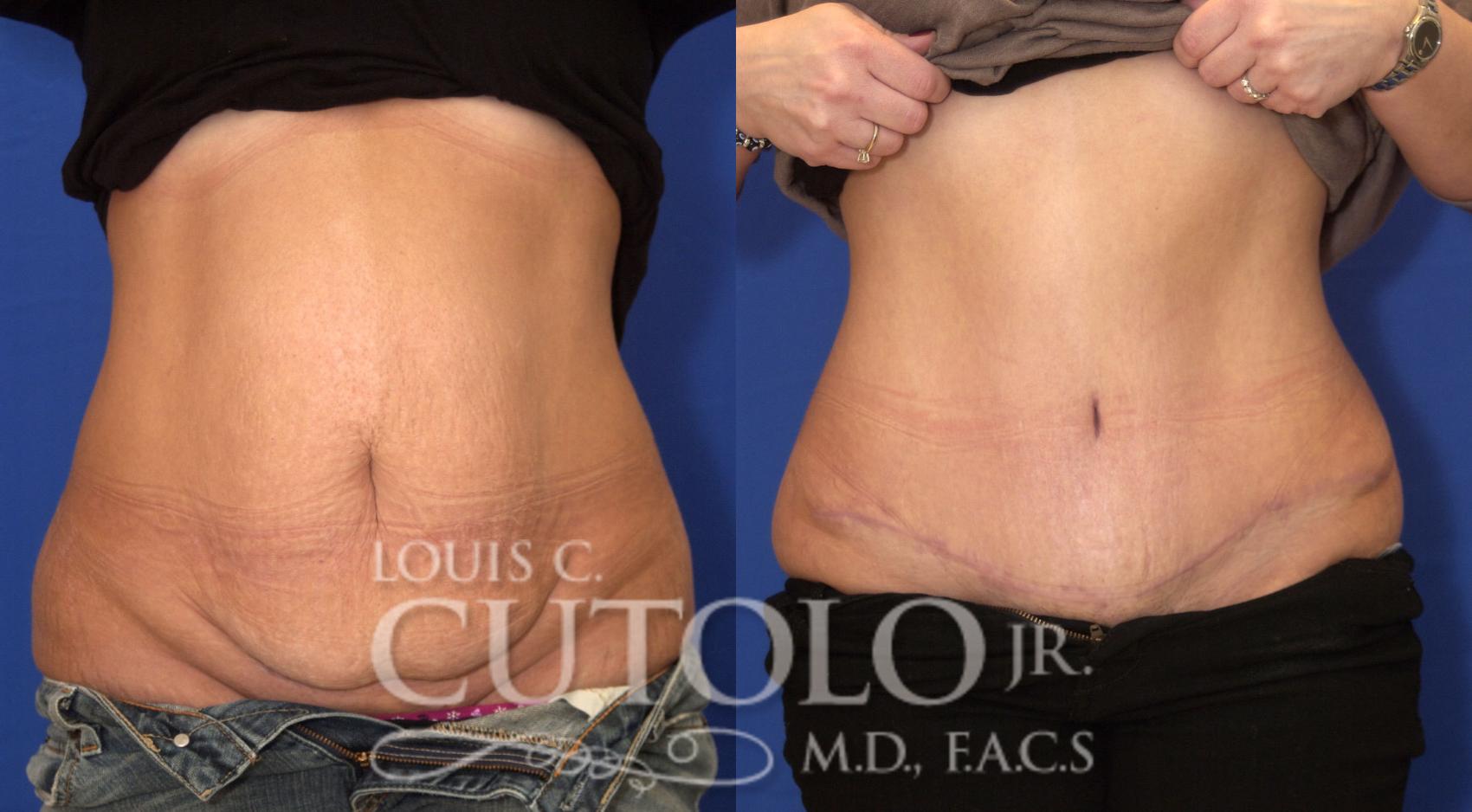 Before & After Tummy Tuck Case 26 View #1 View in Brooklyn, Staten Island, Queens, NY