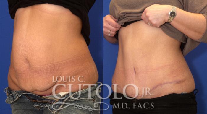 Before & After Tummy Tuck Case 26 View #2 View in Brooklyn, Staten Island, Queens, NY