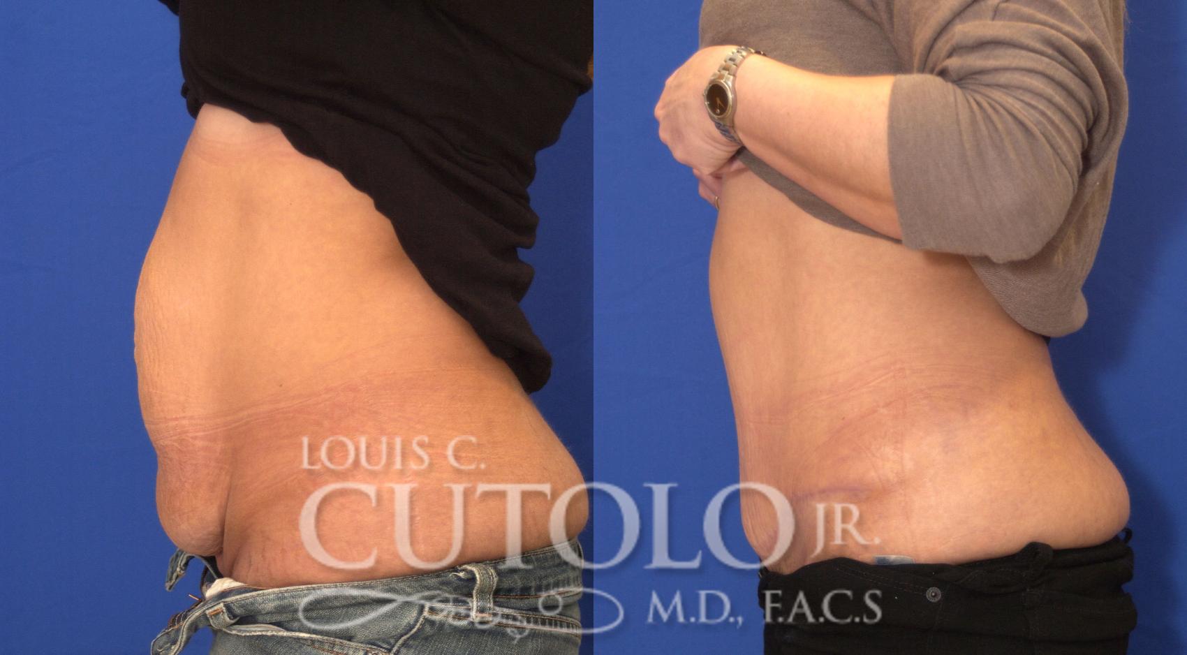 Before & After Tummy Tuck Case 26 View #3 View in Brooklyn, Staten Island, Queens, NY