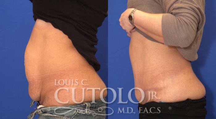 Before & After Tummy Tuck Case 26 View #3 View in Brooklyn, Staten Island, Queens, NY
