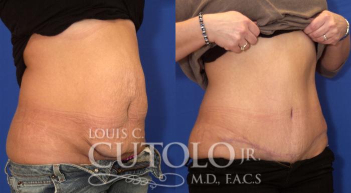 Before & After Tummy Tuck Case 26 View #4 View in Brooklyn, Staten Island, Queens, NY