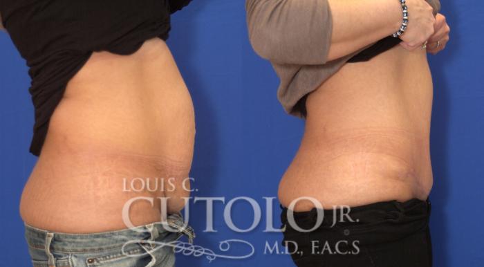 Before & After Tummy Tuck Case 26 View #5 View in Brooklyn, Staten Island, Queens, NY