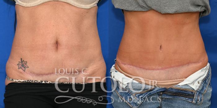 Anterior before