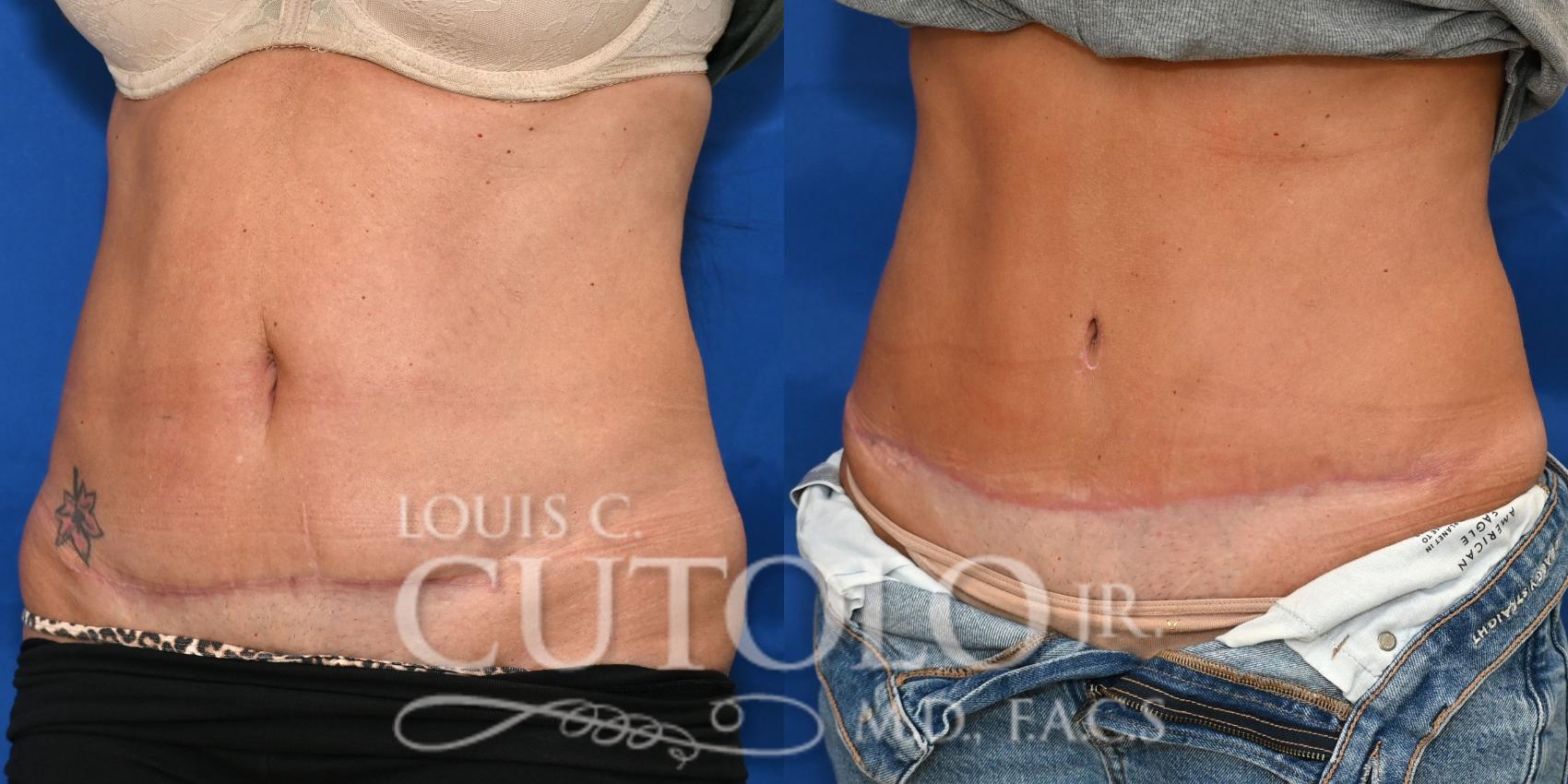 Left Oblique before