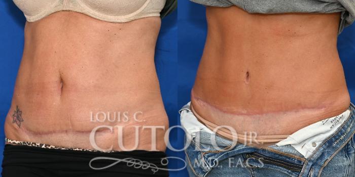Left Oblique before