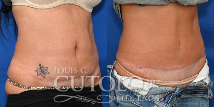 Right Oblique Before