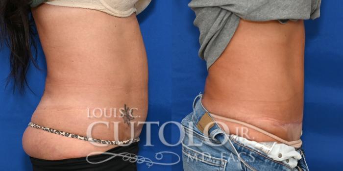 Right Lateral Before