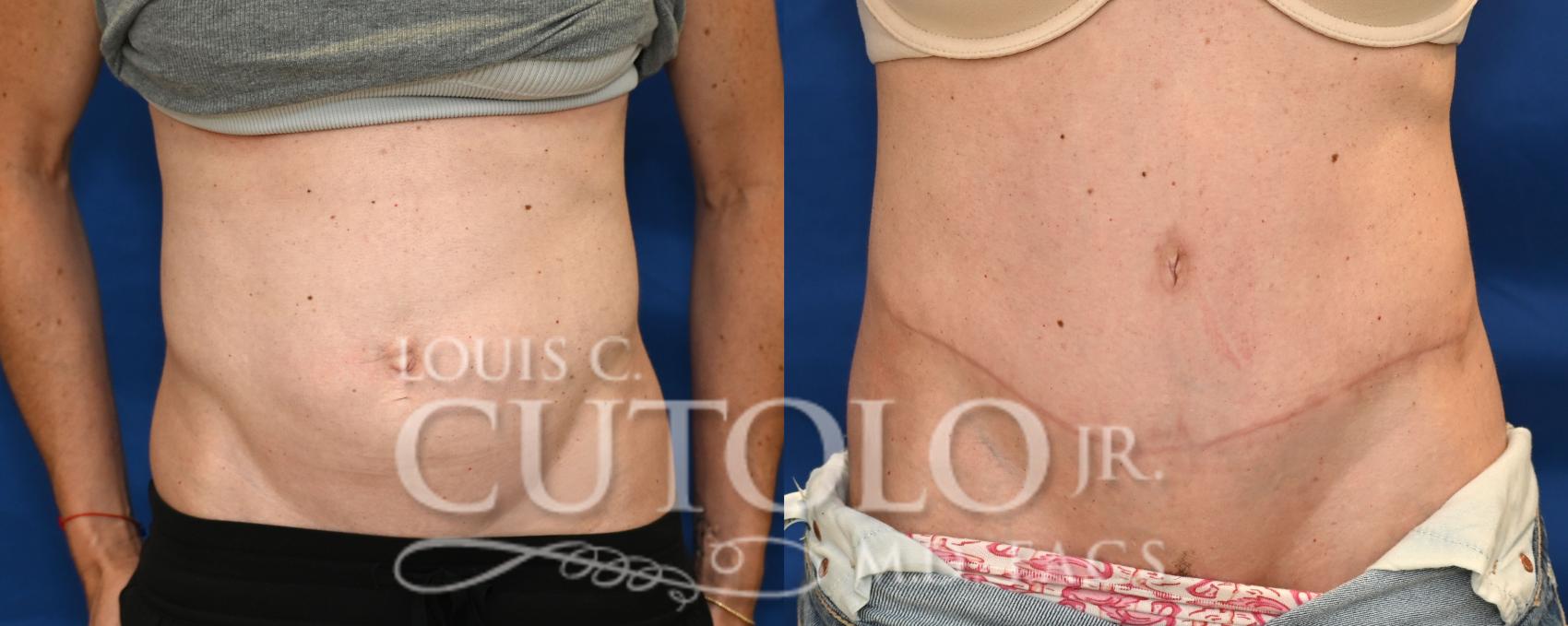 Anterior before