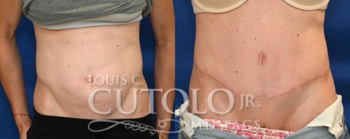 Anterior before