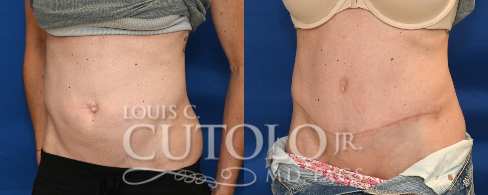 Left Oblique before