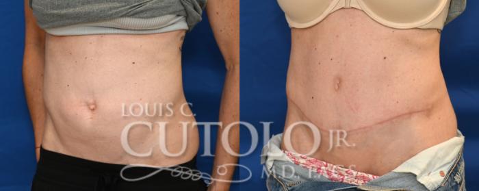 Left Oblique before
