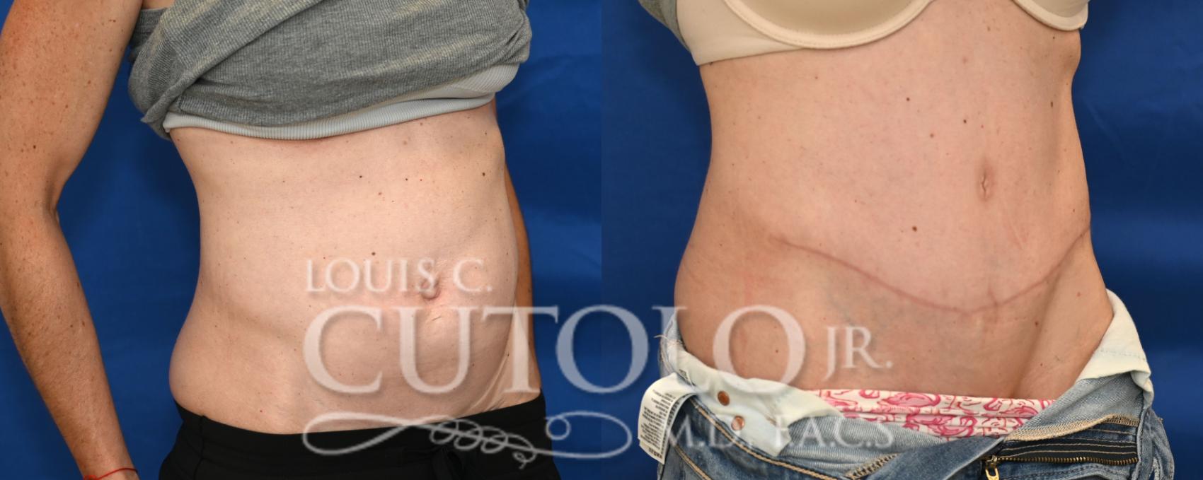 Right Oblique Before
