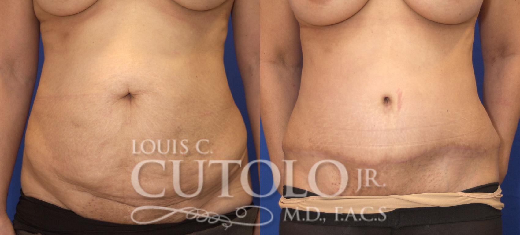 Before & After Tummy Tuck Case 28 View #1 View in Brooklyn, Staten Island, Queens, NY