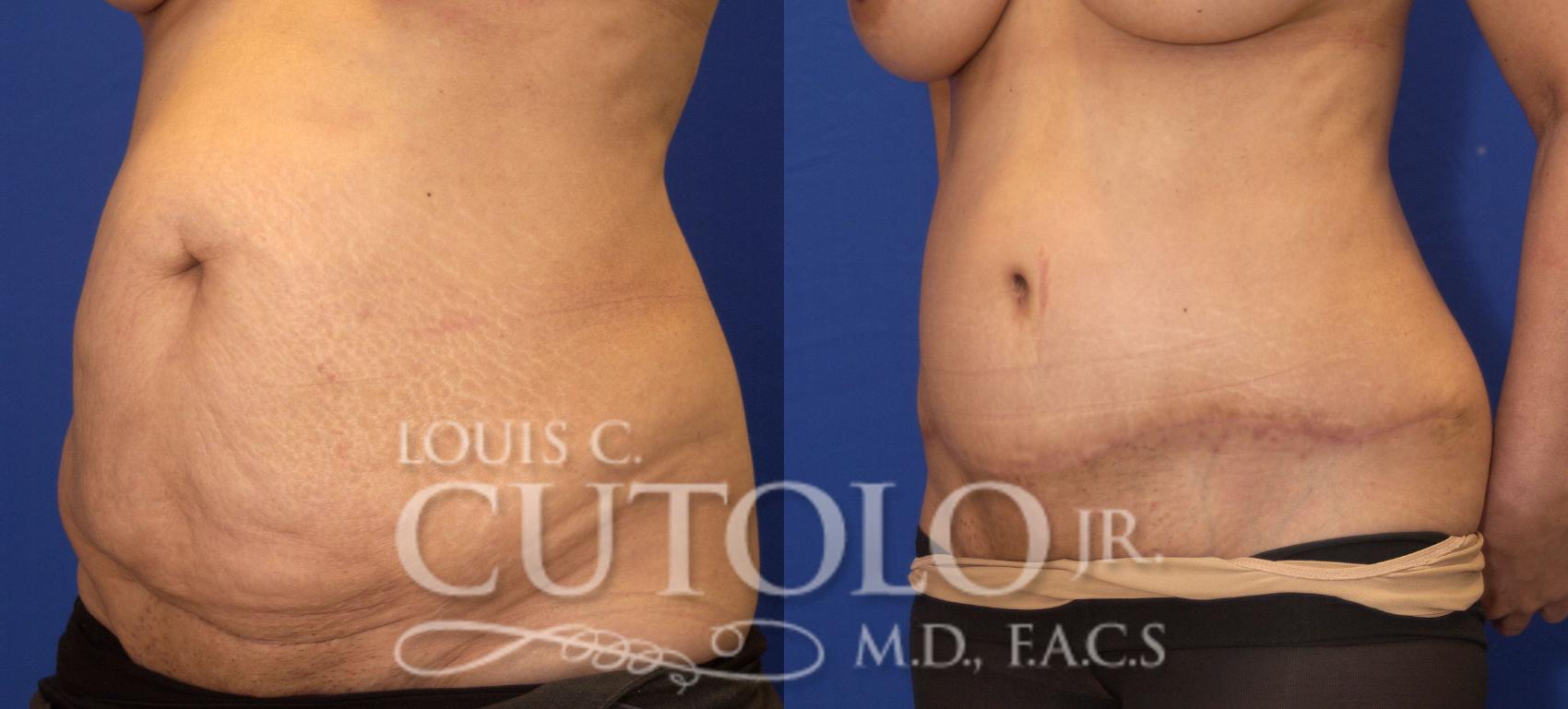 Before & After Tummy Tuck Case 28 View #2 View in Brooklyn, Staten Island, Queens, NY