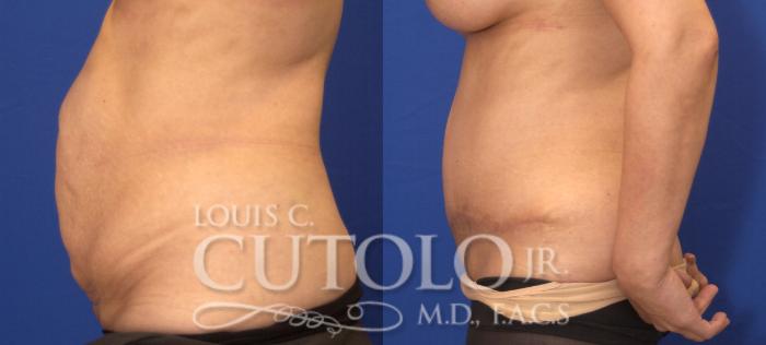 Before & After Tummy Tuck Case 28 View #3 View in Brooklyn, Staten Island, Queens, NY