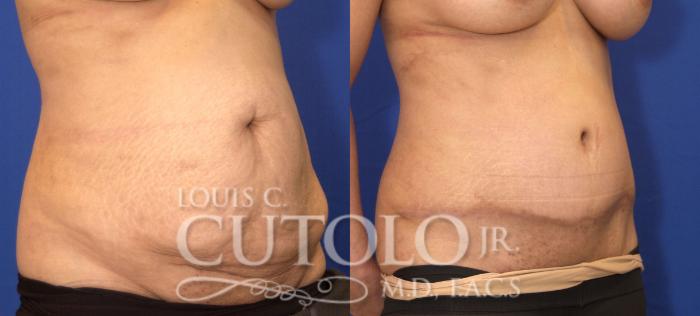 Before & After Tummy Tuck Case 28 View #4 View in Brooklyn, Staten Island, Queens, NY