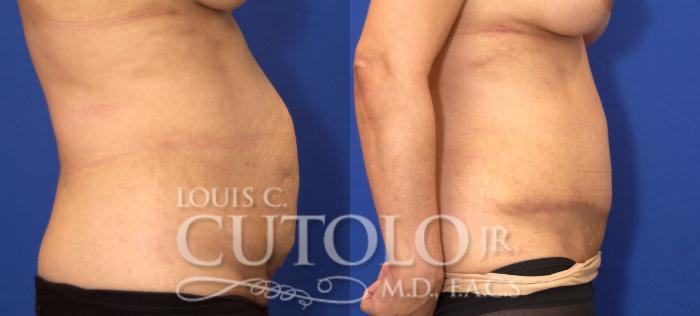 Before & After Tummy Tuck Case 28 View #5 View in Brooklyn, Staten Island, Queens, NY