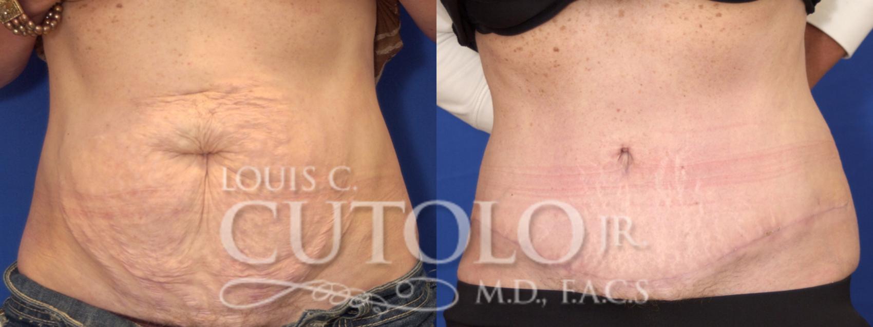 Before & After Tummy Tuck Case 3 View #1 View in Brooklyn, Staten Island, Queens, NY