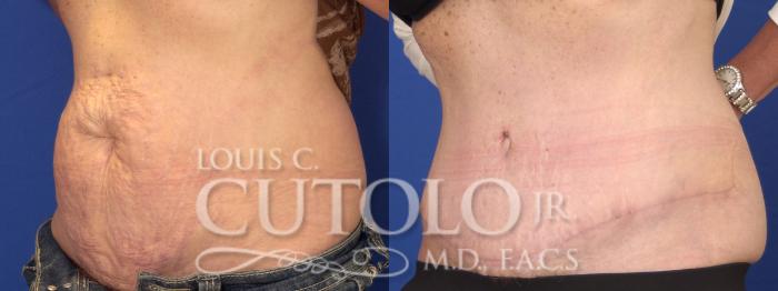 Before & After Tummy Tuck Case 3 View #2 View in Brooklyn, Staten Island, Queens, NY