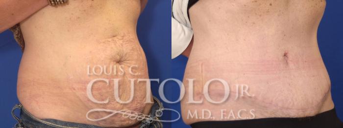 Before & After Tummy Tuck Case 3 View #3 View in Brooklyn, Staten Island, Queens, NY