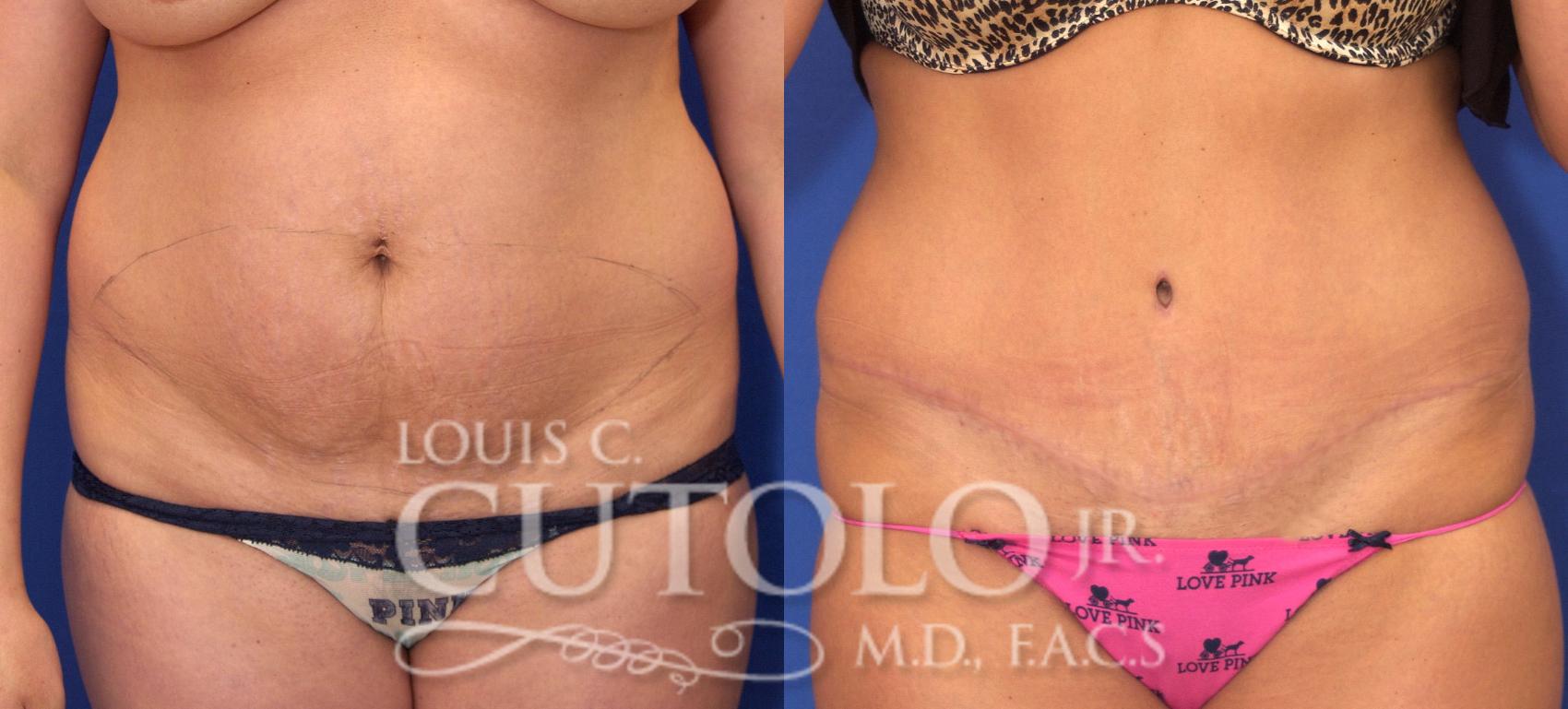 Before & After Tummy Tuck Case 32 View #1 View in Brooklyn, Staten Island, Queens, NY