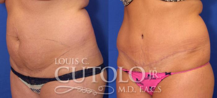 Before & After Tummy Tuck Case 32 View #2 View in Brooklyn, Staten Island, Queens, NY
