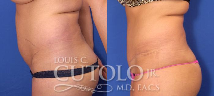 Before & After Tummy Tuck Case 32 View #3 View in Brooklyn, Staten Island, Queens, NY