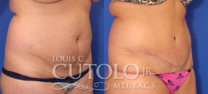 Before & After Tummy Tuck Case 32 View #4 View in Brooklyn, Staten Island, Queens, NY