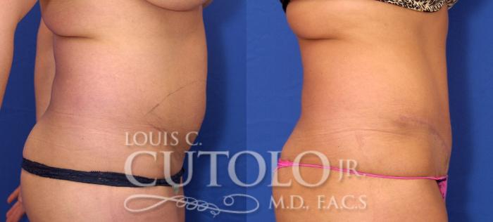 Before & After Tummy Tuck Case 32 View #5 View in Brooklyn, Staten Island, Queens, NY